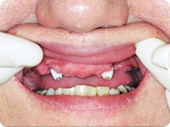 前歯が欠損