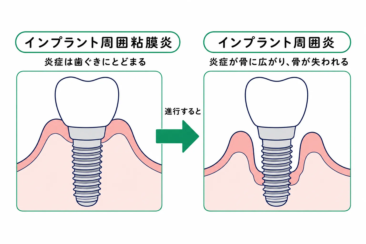 インプラントも歯周病になる？歯茎の炎症が起こる仕組みと予防策